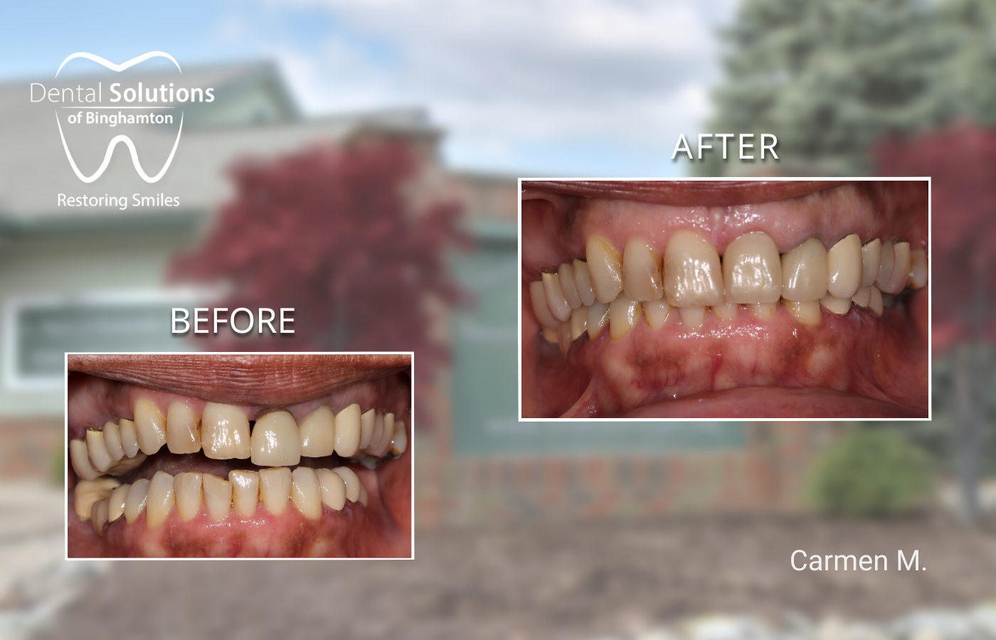 Dental Implants near Vestal, NY