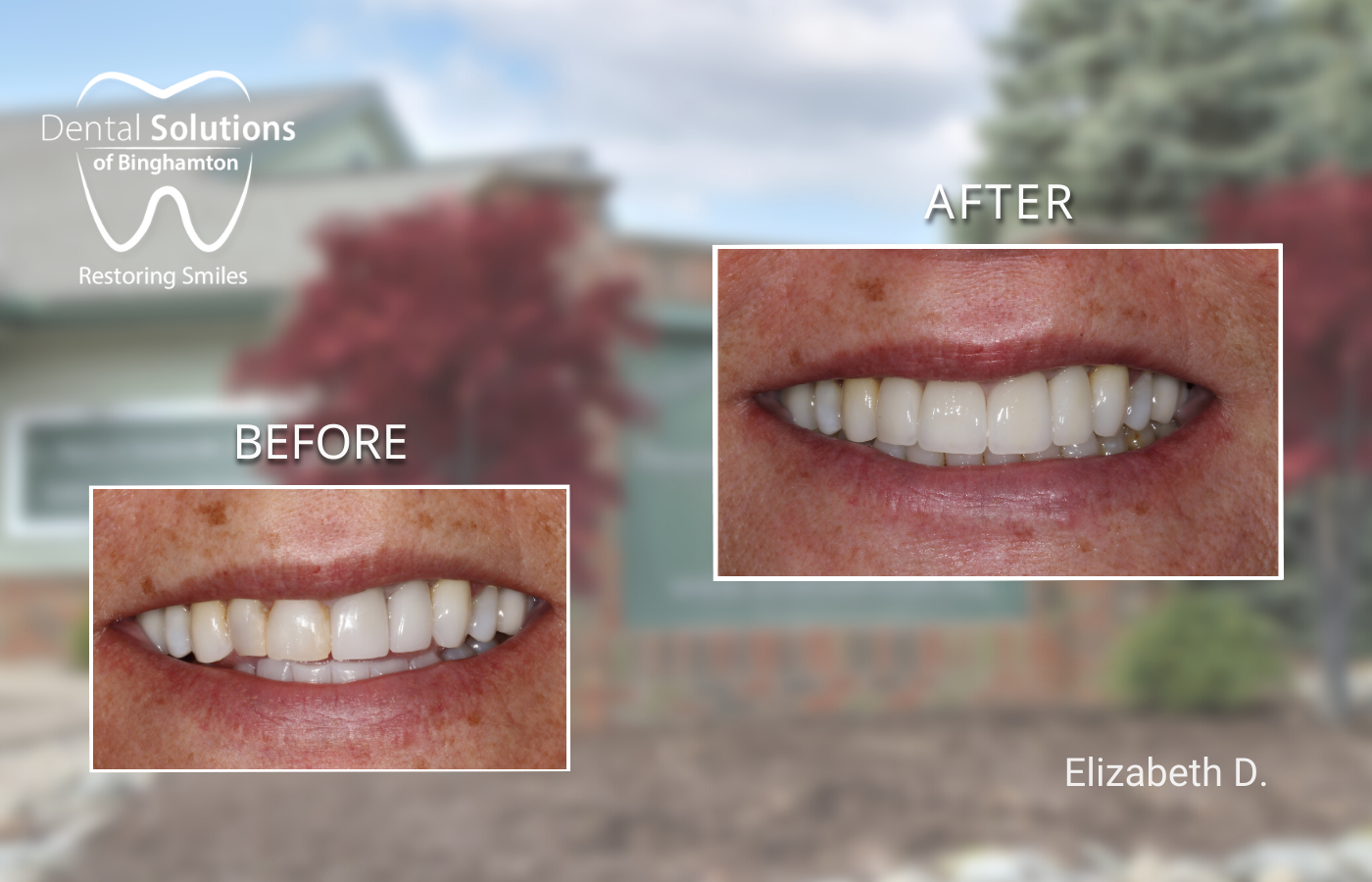 Dental Crowns Vestal, NY