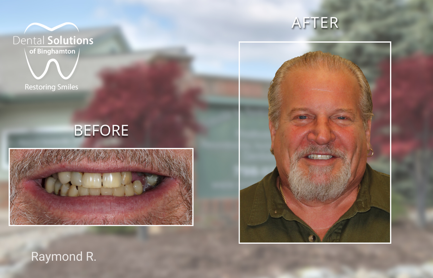 Hybridge Dental Implants